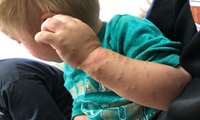 امتناع از واکسیناسیون عامل ابتلا کودک 2ساله به بیماری مسری سرخک در کاشان